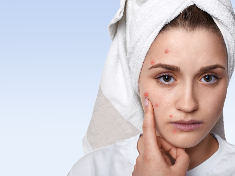 rahasia ampuh atasi jerawat membandel secara alami