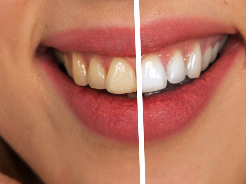 cara mengatasi gigi lebih putih secara alami dan aman