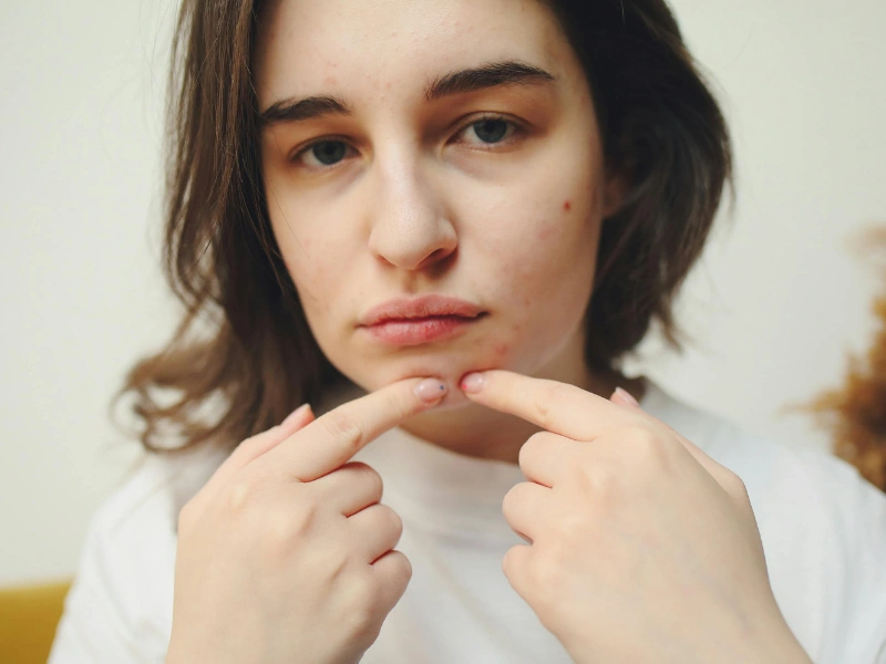 apakah memencet jerawat bisa menyebabkan jerawat bertambah banyak