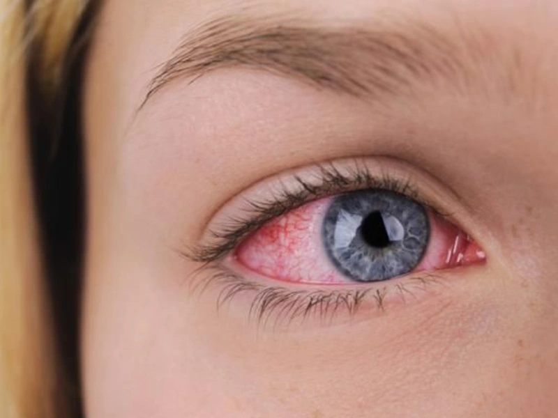 cara mengatasi dry eye agar mata lebih sehat dan nyaman