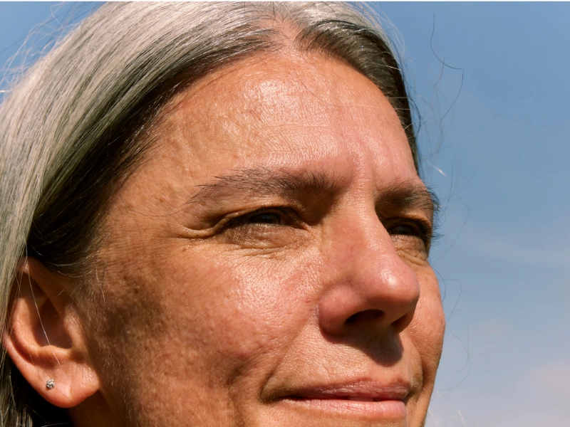 cara menghilangkan kerutan di wajah secara medis