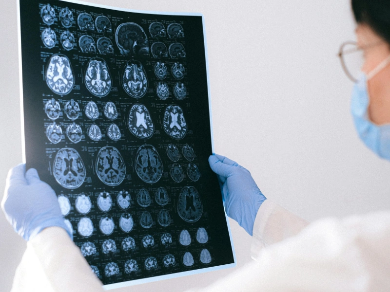 gejala awal tumor otak yang sering diabaikan