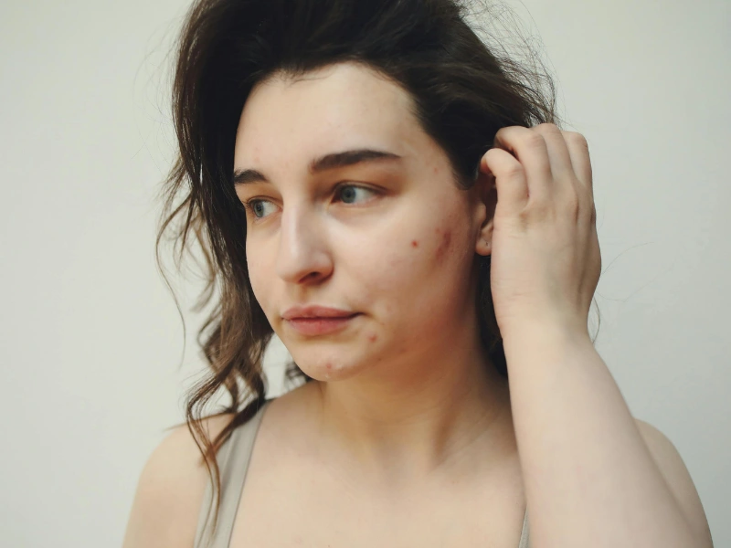 letak jerawat dan penyebabnya yang wajib kamu ketahui