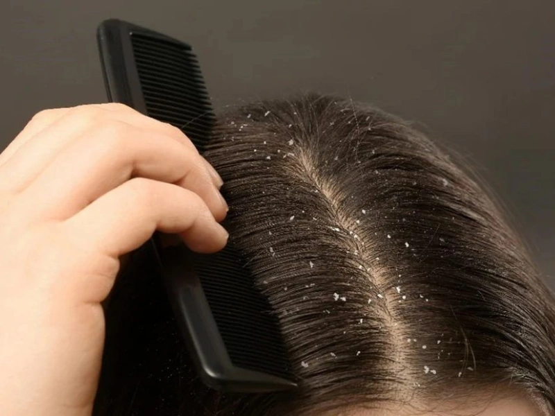 tips rawat scalp barrier agar ketombe tak datang lagi