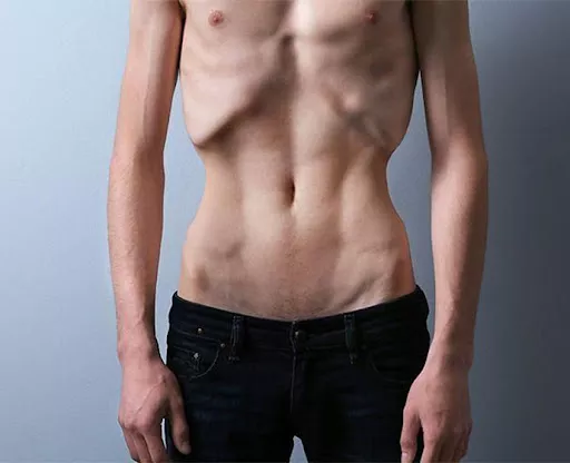 Anoreksia Gejala