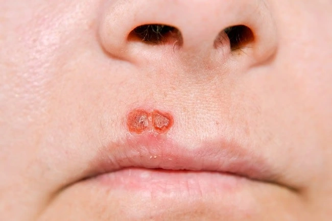 Herpes Infeksi Virus